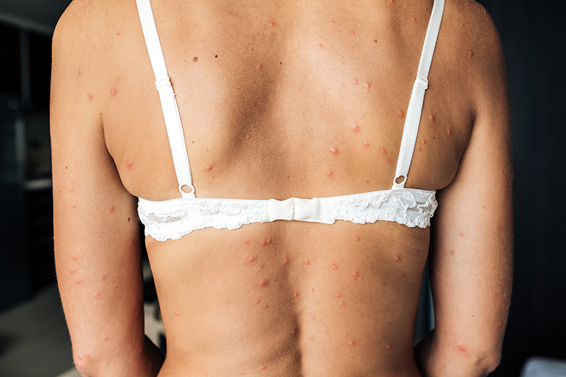 Close up of bed bug bites on skin